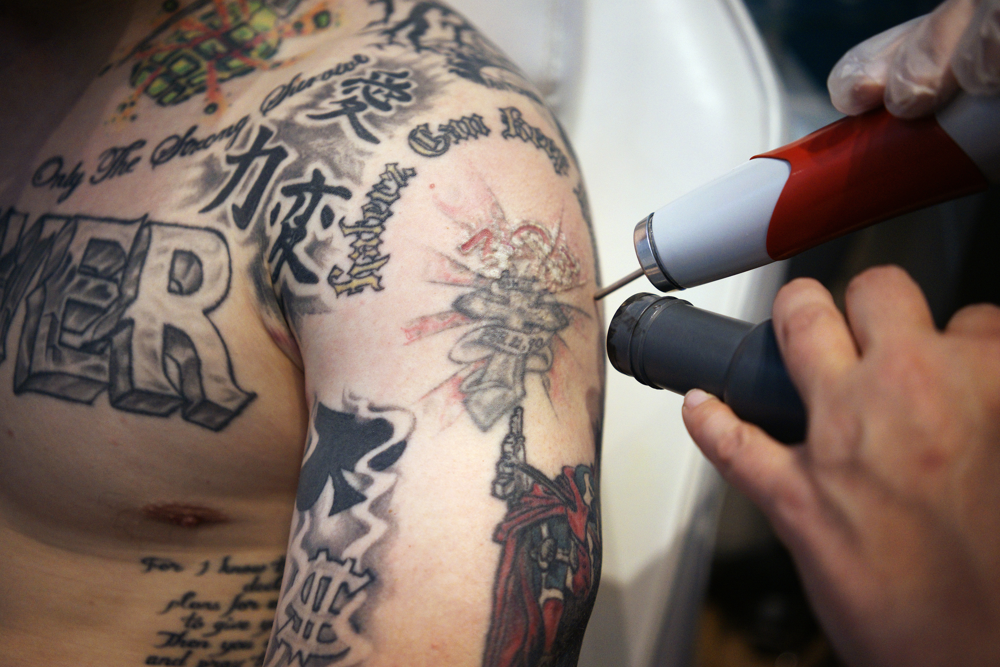 Best Tattoo Removal Cost in Fairfax Virginia  Northern VA Med Spa